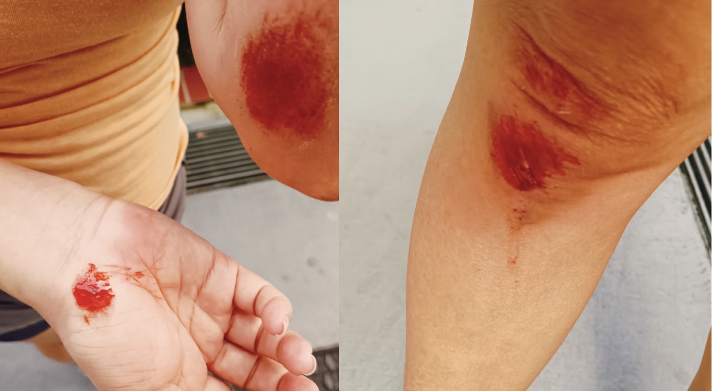 Woman gets injured after PMD hit-and-run; has a message for the rider